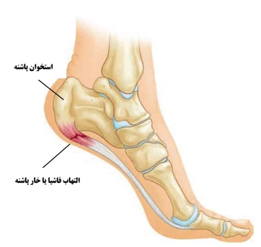 تمرینات خار پاشنه: ۶ حرکت برای کاهش درد با تصاویر