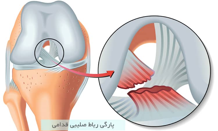 پارگی رباط صلیبی قدامی