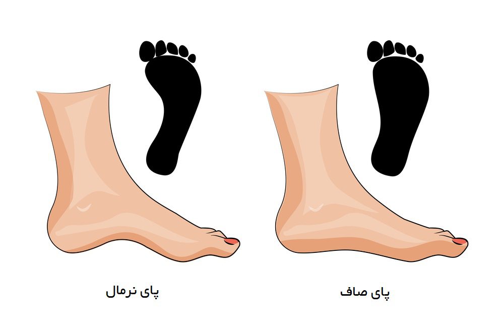 دویدن با کف پای صاف